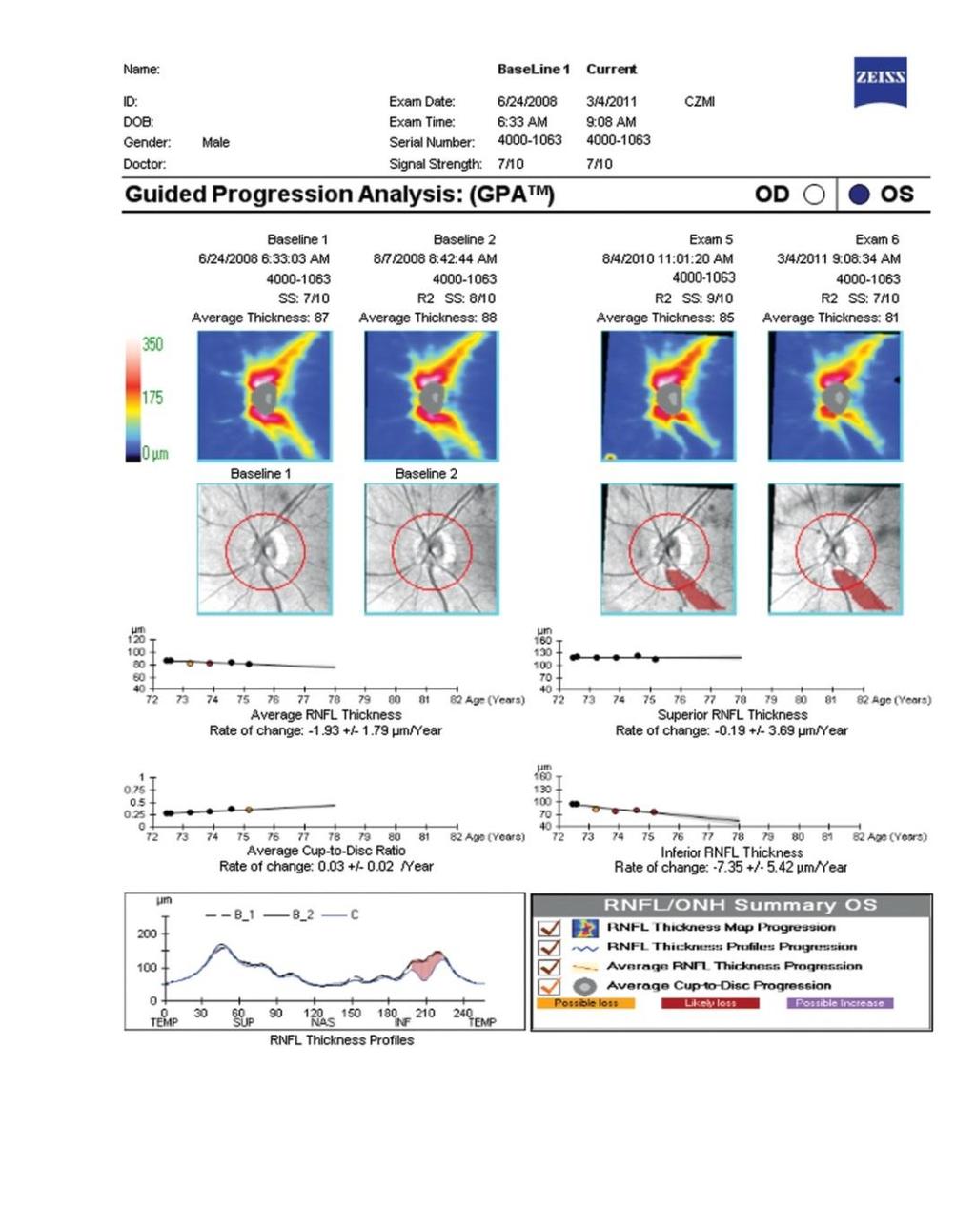 Guided Progression Analysis RSLT Kalınlık Haritası EVENT ANALİZİ Fokal değişim için en iyi RSLT Kalınlık (Ort, Sup, Inf) TREND ANALİZİ
