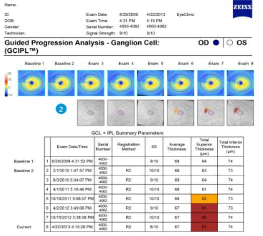 Guided Progression Analysis 2 Ganglion Cell