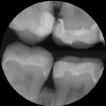 03 Silikat Porselenlerin Intraoral