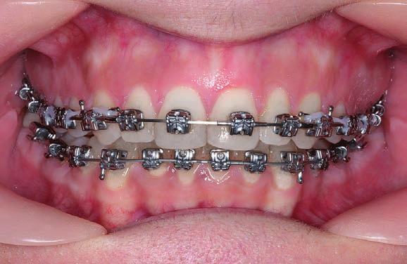 4 ağız içi elastikler ilk ay ve 8 ons ile, 3/16 elastikler 2. Ve 3.
