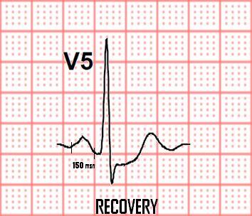 Olgu 1. Olgu-1. Egzersiz stres testinde 4 kat büyütme sonrasında rest ve recovery periyodundaki elektrokardiyografi kompleksleri görülmektedir.