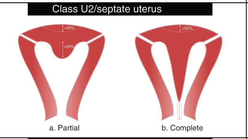 Class U2: internal indentaton >50% of the uterine wall