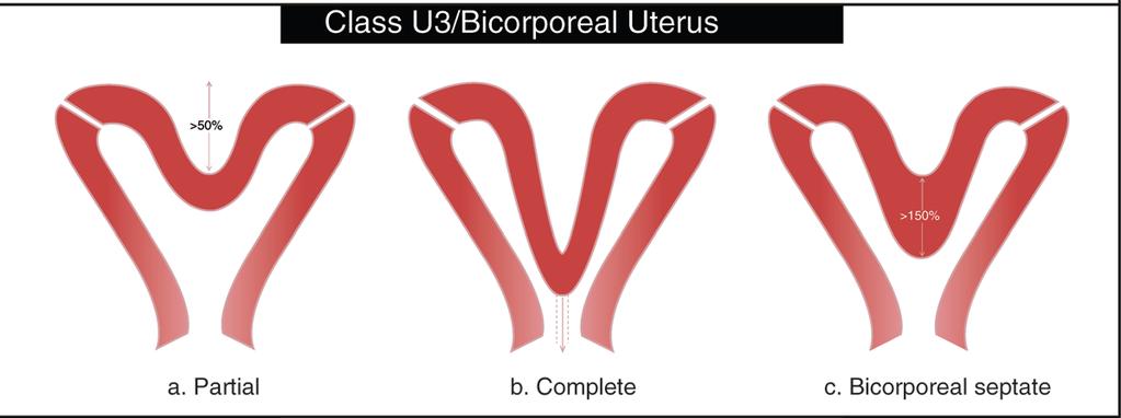 Class U3: External indentaton >50% of the uterine wall thickness, Class U3b: