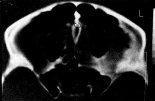 AYDINLIOĞLU ve Ark. Resim 3. Axial planda orbitanın ortasından geçen CT kesitinde paranazal sinuslar ve sfenomaksillar lamina.