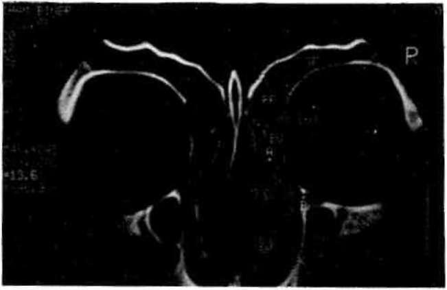 Crista galli'den geçen frontal CT kesitinde paranazal sinusler ve osteomeatal alan görülmekte; SF sinus frontalis; RF recessus frontalis; RT recessus terminalls; BU bulla ethmoidalis; AB