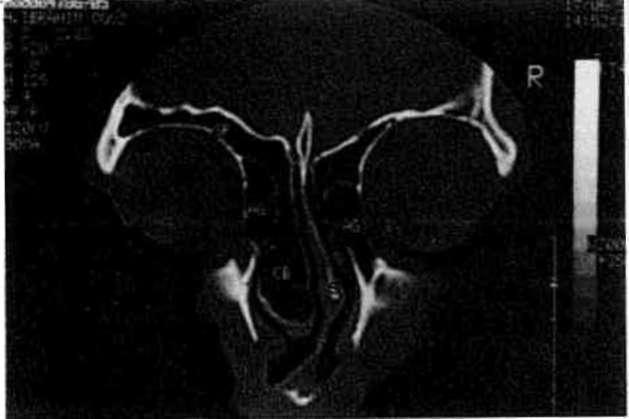 Paranazal sinüslerin cerrahi anatomisi: kadavra ve CT araştırması l-sinus maxillaris ve frontalis 9 medius'a drene olur (20,21).