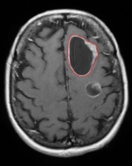 Birinci beyin tümörüne ait görüntü ve histogram bilgileri Şekil 5 deki örnekte belirgin bir tümör görüntüsü vardır.