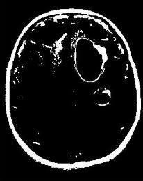 Birinci beyin tümörüne ait görüntü ve histogram bilgileri Şekil 6 de ise histogram grafiğindeki kırmızı ayırıcı çubuğun bu sefer sol