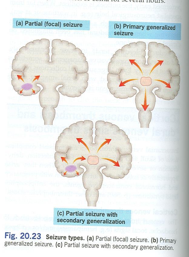 Anormal nöronal deşarjın başlangıç yeri ve yayılımına