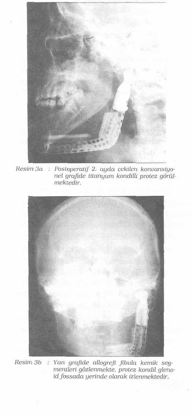 K.B.B. ve Baş Boyun Cerrahisi Dergisi, 3; 155-159, 1995 rildi. Fossaya 1.25 mm. lik silastik levha sülüre edildikten sonra protez kondil yerine yerleştirildi.
