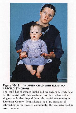 Bunlardan biri Ellisvan Crevald sendromlu, kısa boy, fazla parmak