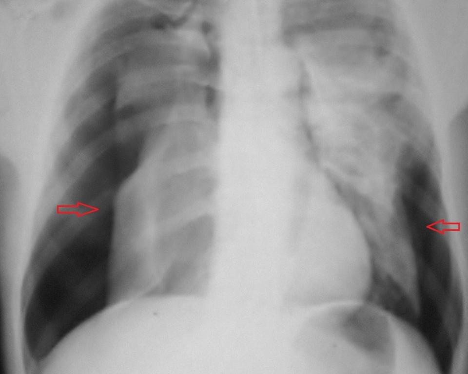Şekil 1 : Postero-anterior akciğer grafisinde, bilateral pnömotoraks görülmektedir. Acil şartlarda hastaya bilateral tüp torakostomi uygulandı.