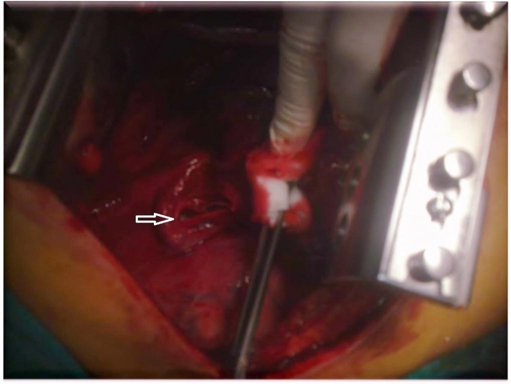 Şekil 3 : Operatif sahada, sağ bronş rüptürü görülmektedir. Bu sırada hastanın desatüre olduğu görülerek operatif sahada entübasyon tüpü sol ana bronş içine yönlendirildi.