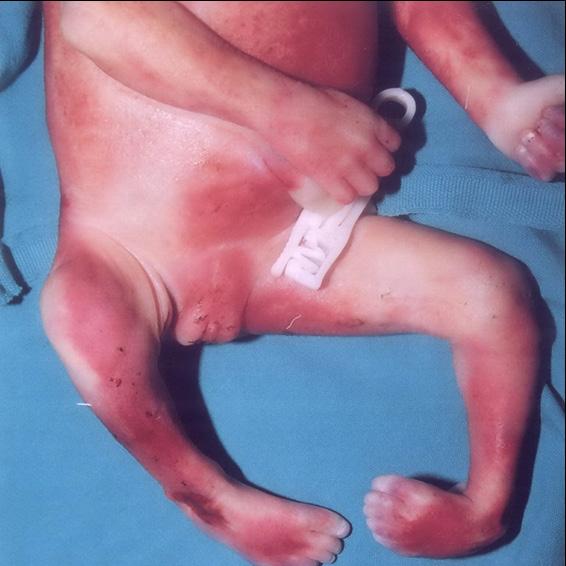 (B) Clubfoot izlenen bu fetüsün kadavra görünümünde solda izlenen deformite US görünümü ile paralellik taşımaktadır. B A Resim 11. A, B. (A) Rockerbottom ayak US görünümü.
