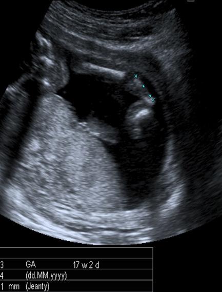 Fetal İskelet Sistemi Anomalileri 295 A Resim 12. A, B. (A) Radial Ray deformitesi izlenen fetüste radius hipoplazisinin US görünümü.