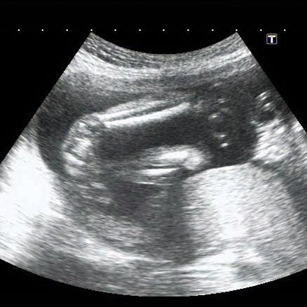 Trizomi 18 olduğu ispatlanan bir fetüsde kamptodaktili görünümü.