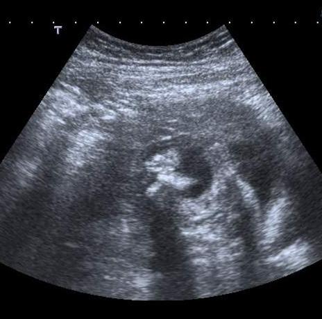 Fetal İskelet Sistemi Anomalileri 289 İskelet Displazilerinin Prenatal Tanısında Göze Çarpan Noktalar 1. Neredeyse her zaman tanı sonografi ile konulur.