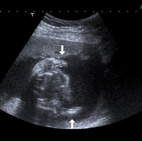 Fetal İskelet Sistemi Anomalileri 291 Resim 7. Akondrogenezisli fetüs. Transvers olarak toraks görüntülenirken şiddetli üst ekstremite mikromelisi bilateral olarak görüntü alanına girmiştir (oklar).