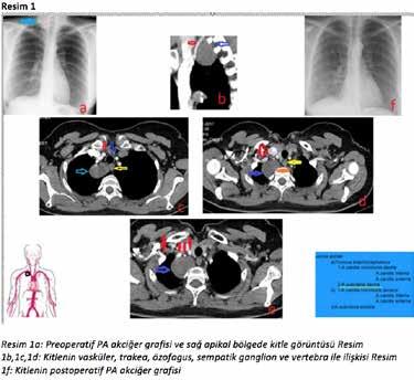 ULUSAL AKCİĞER SAĞLIĞI KONGRESİ UASK 2018 14-18 Mart 2018 Kaya Palazzo Resort Hotel Belek/Antalya PS-027 Sağ Kupula Subklavien ve Vertebral Arter Komşuluğunda Schwannoma; Radyolojik Görüntü ve