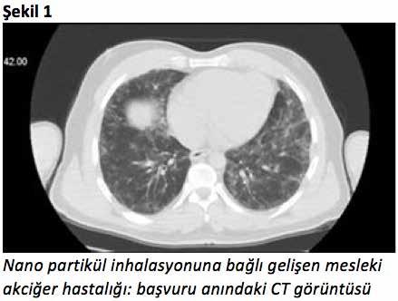 ULUSAL AKCİĞER SAĞLIĞI KONGRESİ UASK 2018 14-18 Mart 2018 Kaya Palazzo Resort Hotel Belek/Antalya PS-312 Nanopartikül İnhalasyonuna Bağlı İnterstisyel Akciğer Hastalığı Olgusu Mustafa Buğra COŞKUNER,