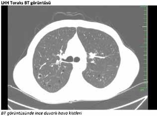 ULUSAL AKCİĞER SAĞLIĞI KONGRESİ UASK 2018 14-18 Mart 2018 Kaya Palazzo Resort Hotel Belek/Antalya PS-332 Pnömotoraks İle Başvuran Pulmoner Langerhans Hücreli Histiyositozis Cihan AYDİN 1, Didem