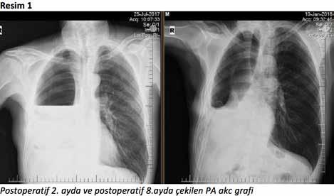 ULUSAL AKCİĞER SAĞLIĞI KONGRESİ UASK 2018 14-18 Mart 2018 Kaya Palazzo Resort Hotel Belek/Antalya PS-043 Geç Dönem Postoperatif Ampiyem Ve Bronkoplevral Fistül Nedeni: Mikobakterium Tüberkülözis