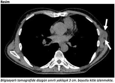 Sizin Sesiniz, Sizin Kongreniz... PS-048 Nodüler Fasiit: Malign Görünümlü Benign Bir Lezyon Banu YOLDAŞ 1, Ezgi Çimen GÜVENÇ 1, Soner GÜRSOY 1, Figen TÜRK 1, Didem ERSÖZ 2 1 SBU İzmir Dr.