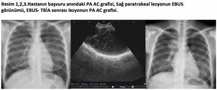 ULUSAL AKCİĞER SAĞLIĞI KONGRESİ UASK 2018 14-18 Mart 2018 Kaya Palazzo Resort Hotel Belek/Antalya PS-004 Endobronşiyal Ultrasonografi Eşliğinde Transbronşiyal İğne Aspirasyonu Sonrası Enfekte Olan