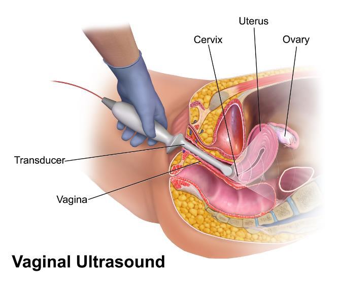 edilir Transabdominal