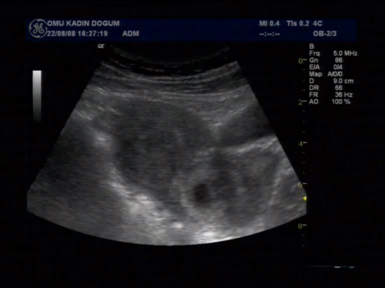 Servikal Gebelik Düşmekte olan gebelik kesesinden ayırıcı tanısı İnternal os açıktır Embriyo