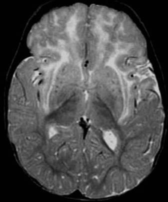 Periventriküler beyaz cevherde rosenthal