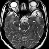 MRG Anterior temporal ve posterior frontal subkortikal kistler Oksipital beyaz cevherde periventriküler rim Bazal ganglion, korpus