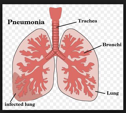 Pnömoni Tanım Bir mikroorganizmanın akciğerlere ulaşması ve