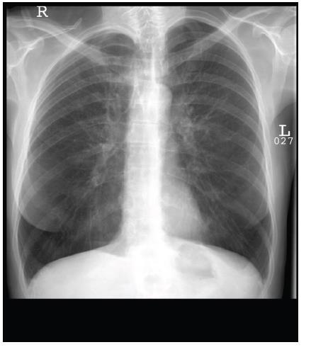 Radyoloji Akciğer grafisi Akciğer hacmi genişleşmiş Diafragma düzleşmiş Kalp gölgesi uzun ve dar(damla