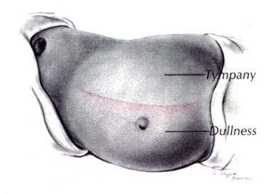 Shifting Dullness Sıvı Dalgası Timpani Matite Dalak Muayenesi Özelliksiz Oskültasyon Barsak sesleri (N: 4-6/dk) Renal,