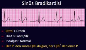 S u p r av e n t r i k ü l e r A r i t m i l e r ( S i n ü s B r a d i k a r d i s i ) Kalp hızı 60 ın altındadır. Her P yi QRS izler. P dalgası D2 derivasyonunda pozitiftir.