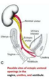 Mesane gelişimi ile ilgili malformasyonlar Ektopik üreter: Üreterler mesonephric duktusun oluşturduğu herhangi bir alana açılabilir.