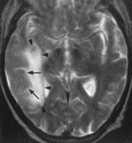 Resim 6. Santral sinir sistemi lenfomas olan 70 yafl nda erkek hasta.