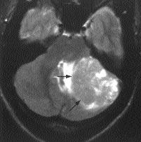 için difüzyon a rl kl görüntülerde hiperintens izlenmiyor. Resim 7. Primitif nöroektodermal tümör.