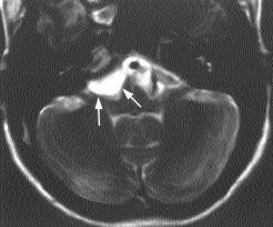 Resim 8. Epidermoid tümör. 37 yafl nda erkek hasta sa tarafta iflitme kayb ile baflvuruyor.