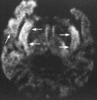u nedenle, baz olgularda difüzyon a rl kl görüntüleme herpes ensefalitinin erken tan s nda oldukça faydal olabilir. mukoid materyaller de k s tlanm ş difüzyon sinyali gösterebilir.