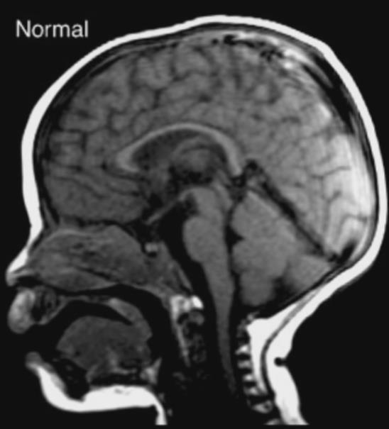 Son derece nadir SSS Tümörleri Pediatrik beyin tümörlerinin %0.5-1.