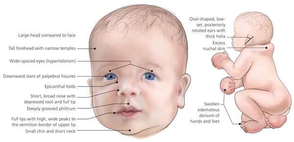 Sendroma özgü tipik yüz şeklini ise hipertelorizm, aşağı çekik palpebral