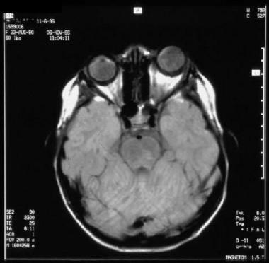 grafileri Beyin MR EEG T2 de sinyal hiperintansitesi İlerleyici makrosefali (hidrosefali chiari
