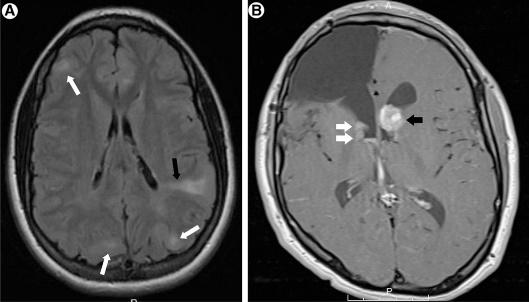 karsinom rabdomiyom, aritmiler Akciğer lenfanjioleiomyomatozis Tuberous