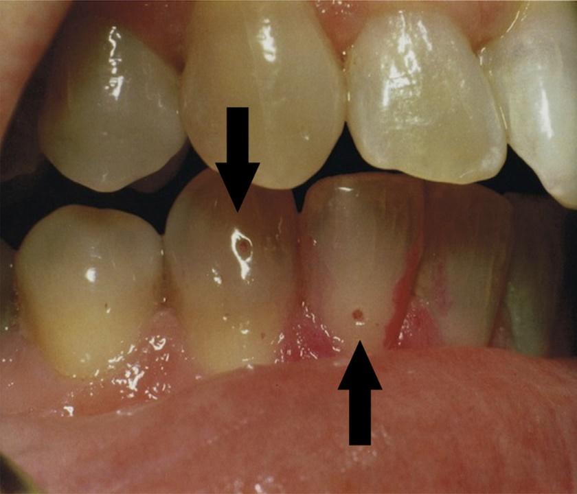 Dental pits