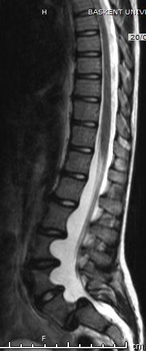 Spinal