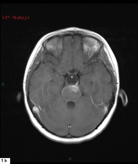 Kontrol beyin MRG de ponsa uzanım gösteren ekspansil karakterde hiperintens lezyon saptandı (Şekil 1).