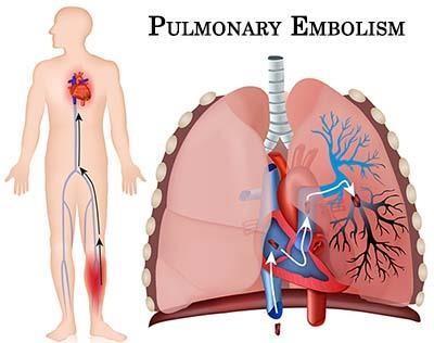 Pulmoner Tromboemboli (PTE) Pulmoner troboemboli (PTE) görece sık karşılaşılan bir kardiyovasküler acil