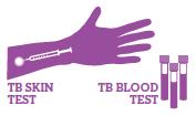 M. Tuberculosis için test etme Mantoux tuberculin skin test (TST) Interferon-gamma release assays (IGRA) LTBI veya aktif TB hastalığını dışlamaz Karar sadece TST veya IGRA ile verilmez 5 mm